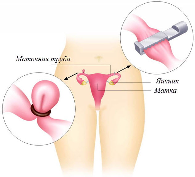 Как работает женская стерилизация
