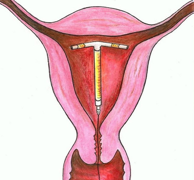 Метод экстренной контрацепции: внутриматочная спираль