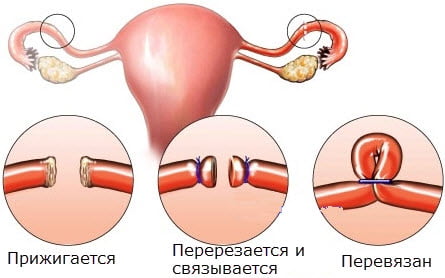 Различные виды стерилизации